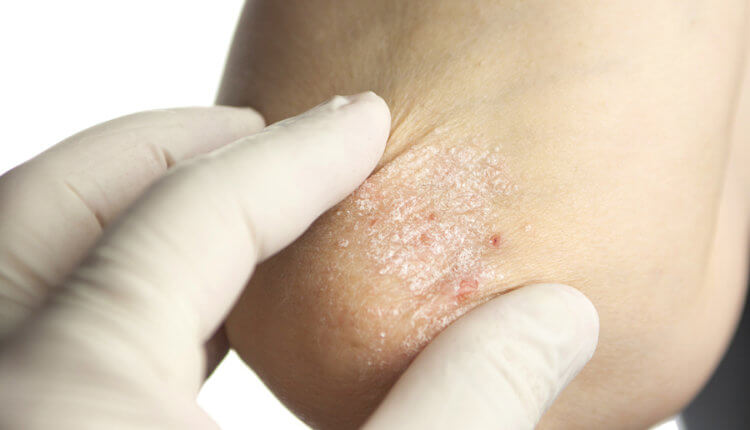 bigstock-Psoriasis